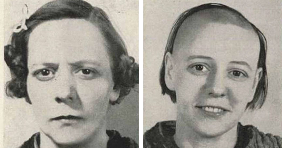 Disturbing Before And After Photos of Lobotomy Patients Will Leave You Concerned About How The Past Handled Mental Health
