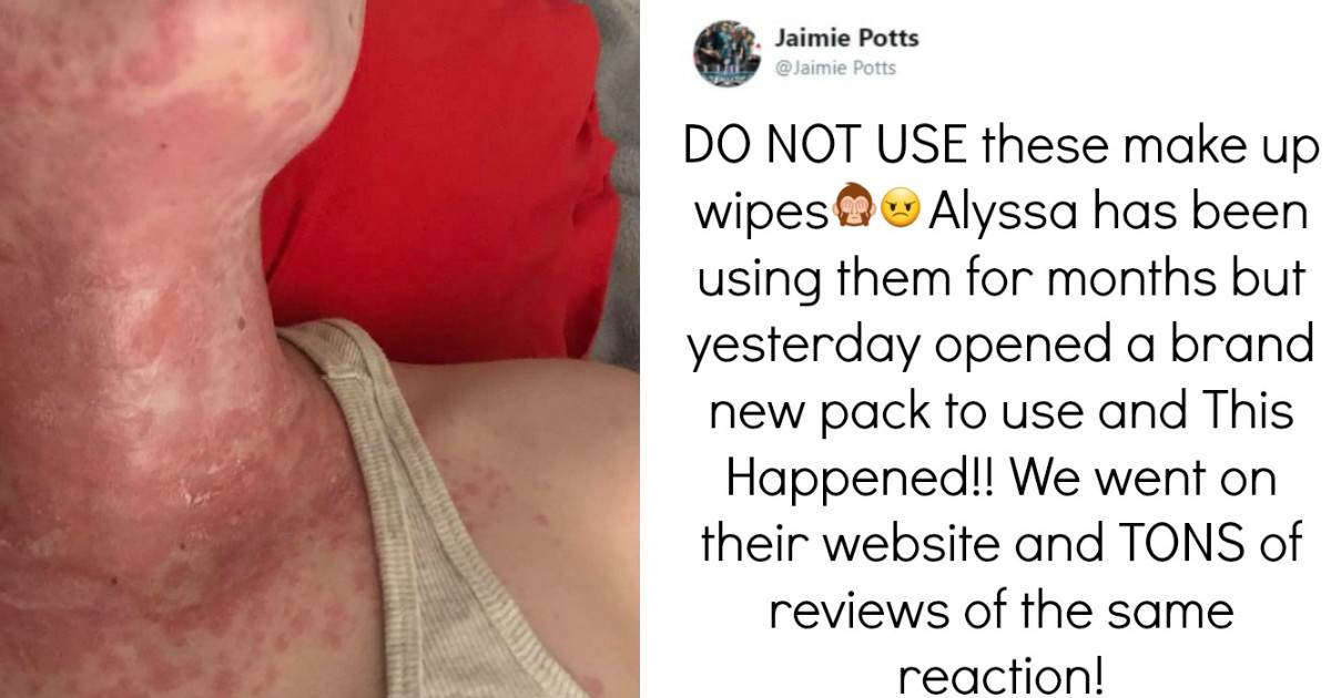 People Share Photos Of The Damage Done To Their Skin After Using These Products