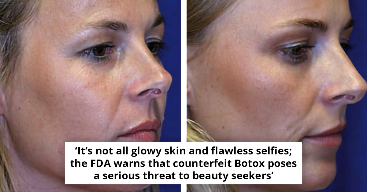 Identical Twins Show Dramatic Aging Differences - Decades Of Botox vs. Aging Naturally