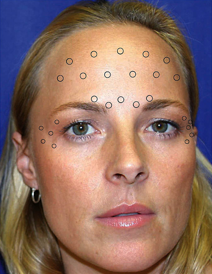 Dr. William targeted specific areas like the forehead and crow’s feet to help the treated twin maintain a youthful appearance