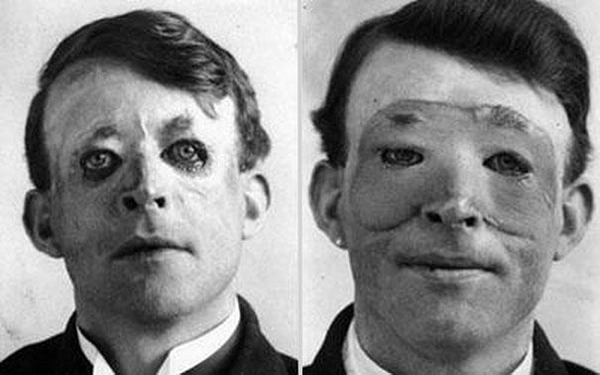 Walter Yeo after undergoing the first ever skin transplant and plastic surgery in 1917.