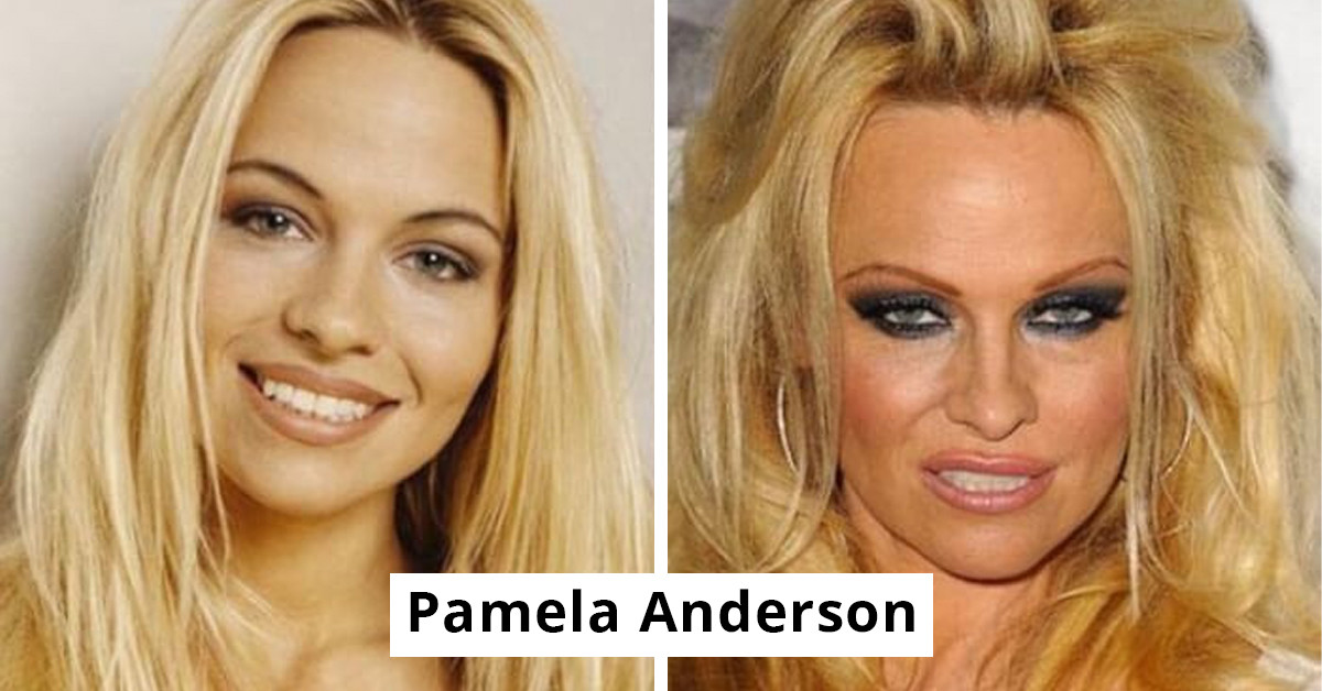 15 Naturally Beautiful Celebrities Who Ruined Their Looks With Cosmetic Surgery