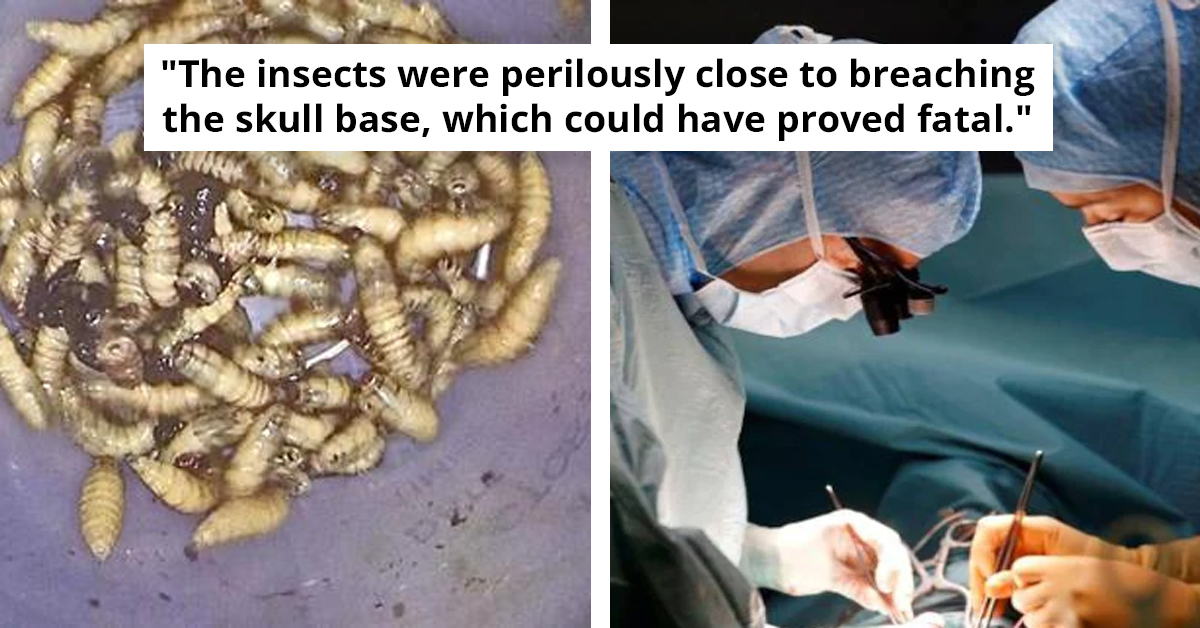 Doctors Remove 150 Live Bugs From Florida Man's Nose