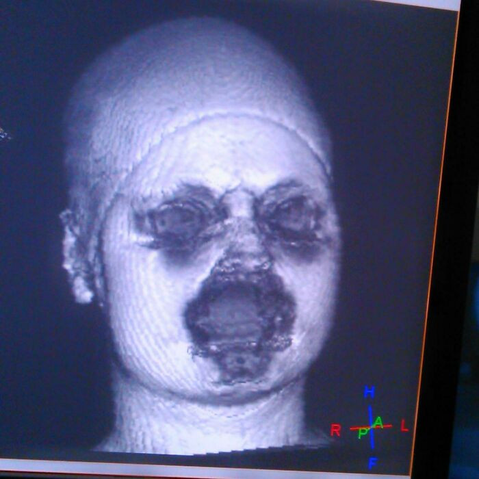 17. This Is What A 3D Mri Reconstruction Of Your Face Looks Like When You Wear Makeup. The Metal Particles In Your Mascara Etc. Disturb The Signal Of The Mri Machine