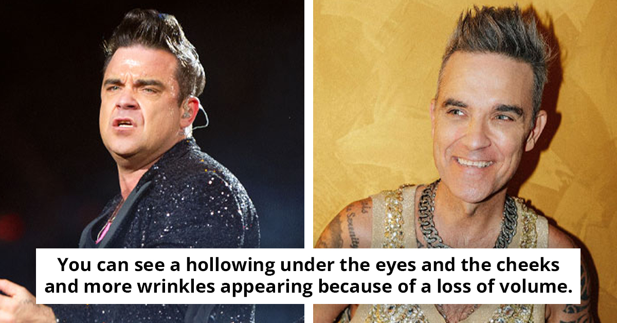 Hollywood Struggles With The Latest Beauty Fad As Many Celebrity Faces Reveal The Alarming Effects Of Ozempic Use