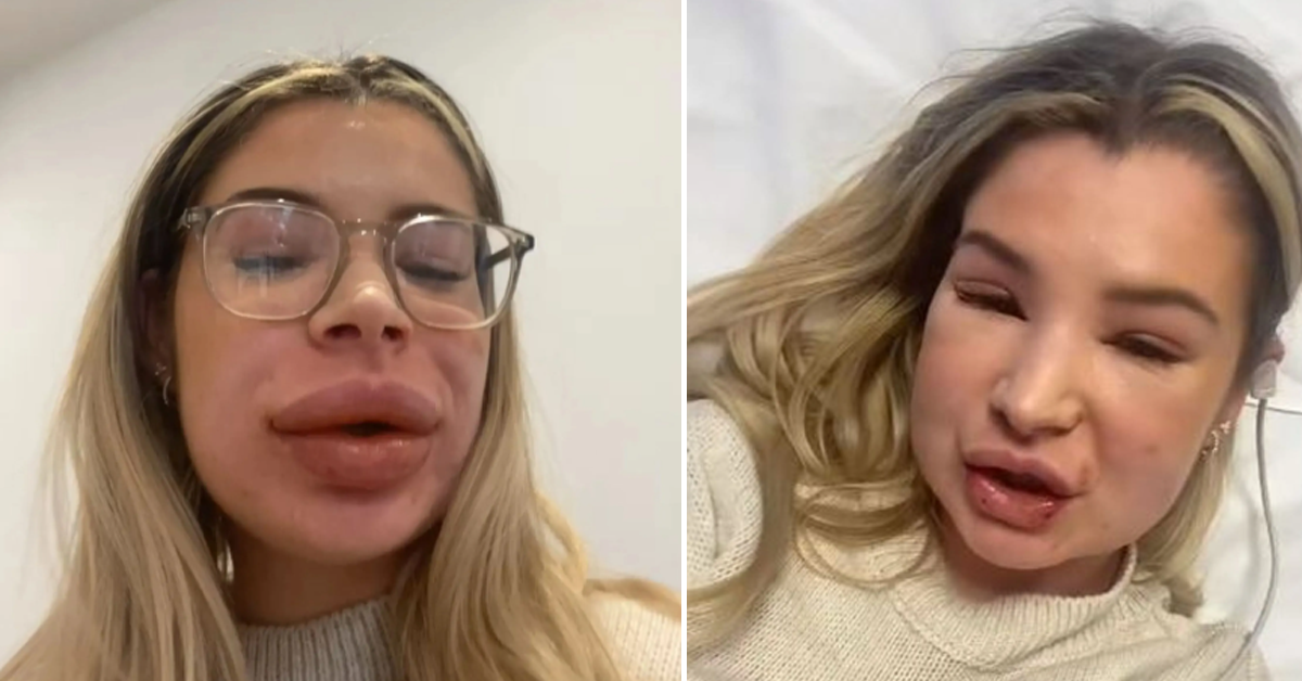 Lip Filler Nightmare - Woman, 24, Left Struggling To Breathe With 'Balloon Face And No Eyes' After Dissolution Procedure