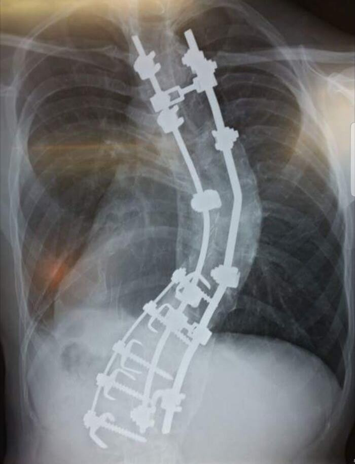 53. My Spine. I Went In For Surgery At 5'10