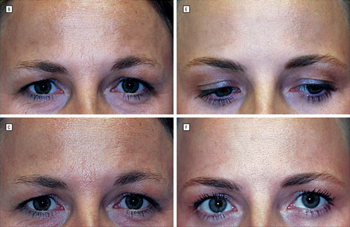 These side-by-side shots prove that Botox definitely smooths out the wrinkles. But can it outshine authenticity?