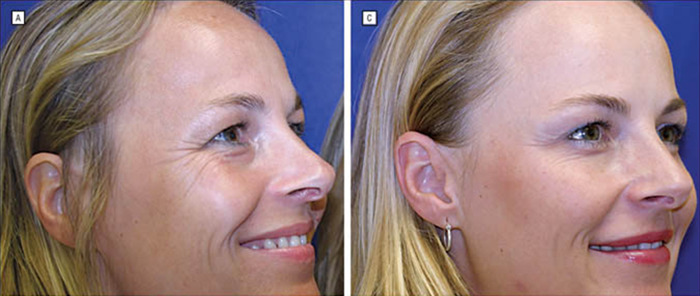 The marked differences between treated and untreated areas reveal the magic (and questions) surrounding Botox.