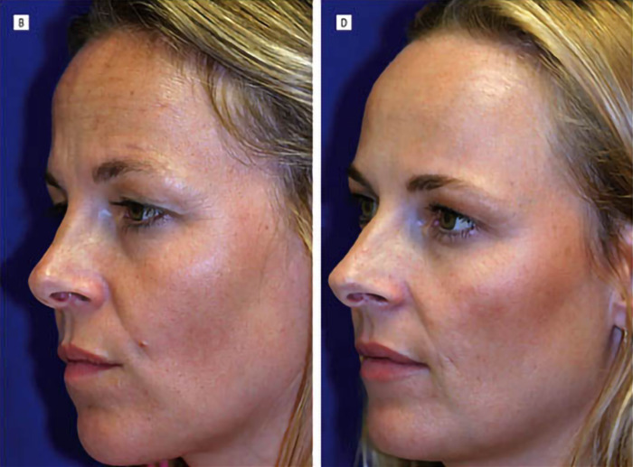 Treated vs. natural—how thirteen years can shape your face and the conversation on beauty standards.