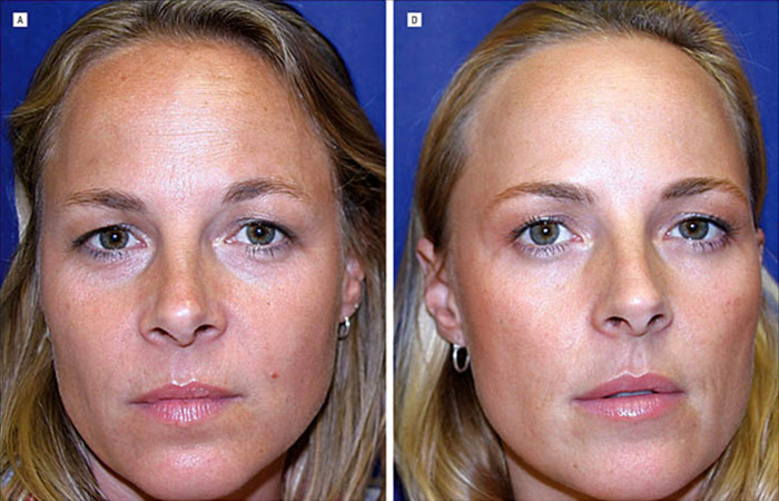 The Wrinkle Debate: Botox vs natural aging—who wore it better?