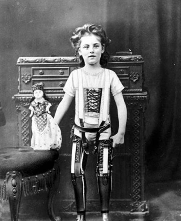 40. A child with artificial legs (1898).
