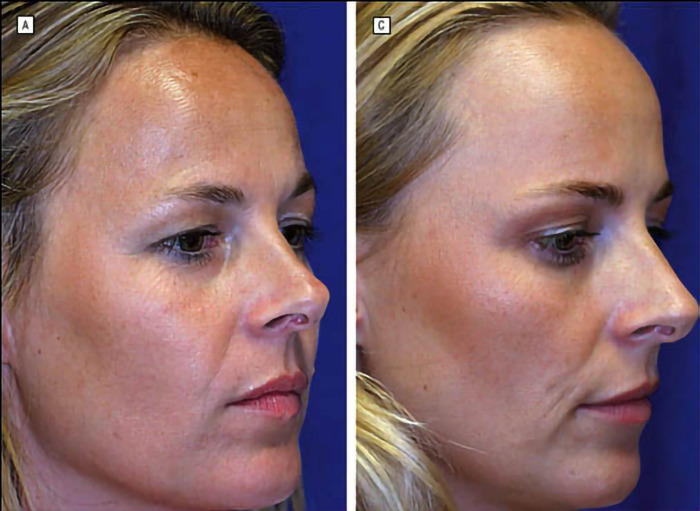 Spot the contrasts,is Botox really the ultimate wrinkle warrior?